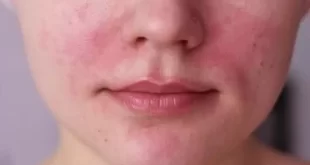 Eczema