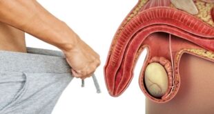 Erectile Dysfunction