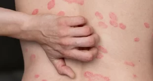 Psoriasis